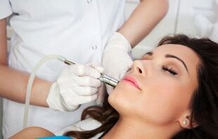 laser removal of warts