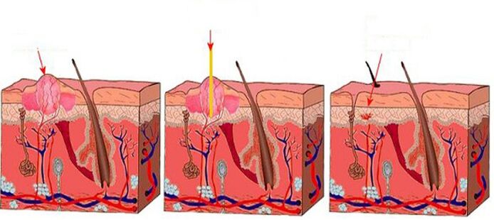 How the laser works on papillomas