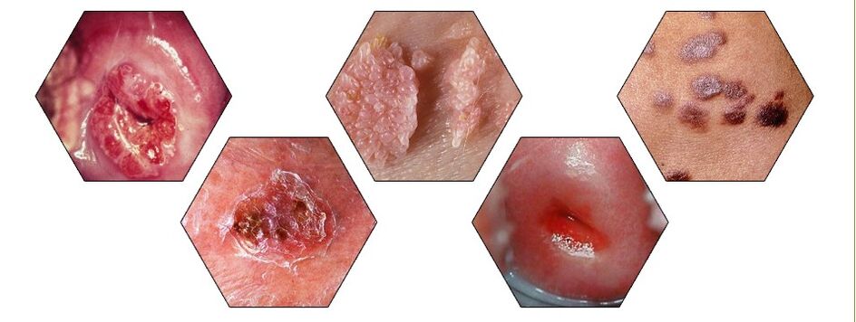 dangerous types of papilloma