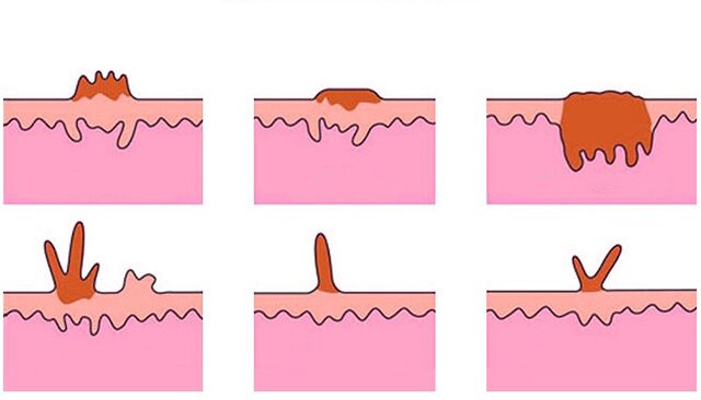 types of papilloma on the body