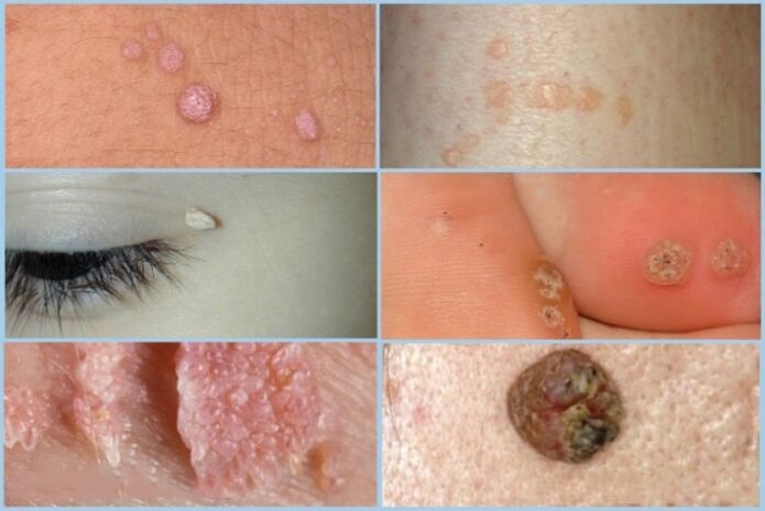 types of papilloma on the face and body