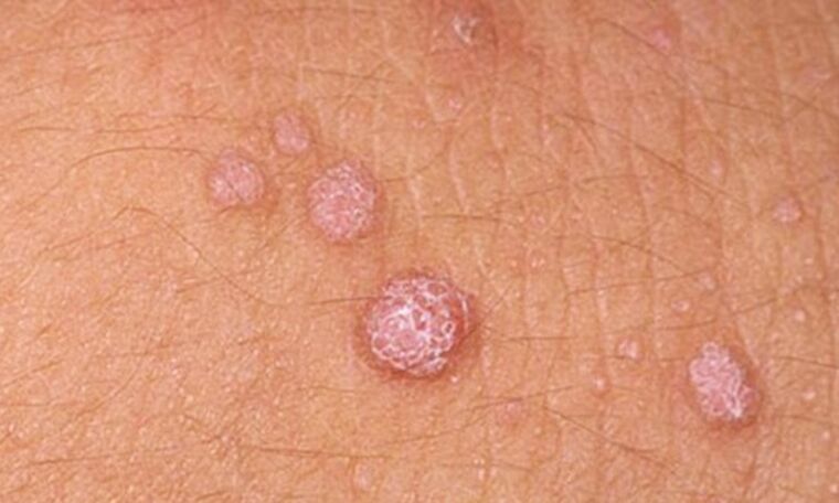 HPV causes the appearance of skin papillomas