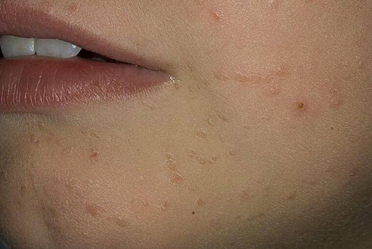 Papillomas on the face