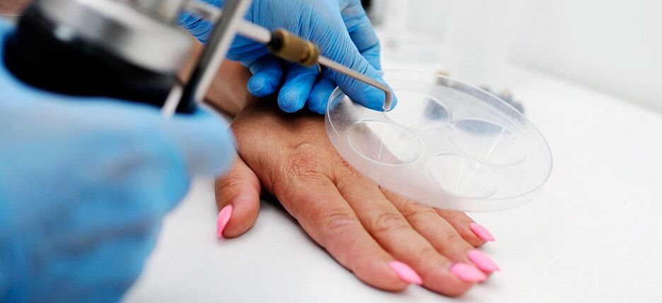 professional removal of warts