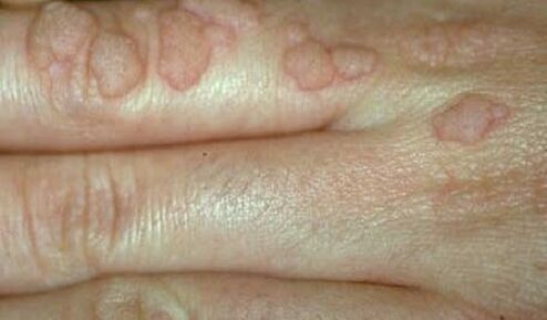 Human papillomavirus on the hands