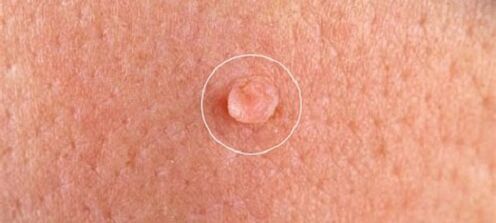 genital warts on the body