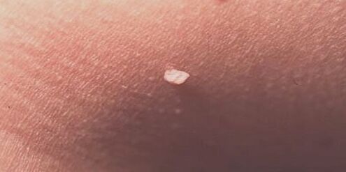 human papillomavirus in the skin