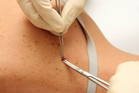 professional removal of warts
