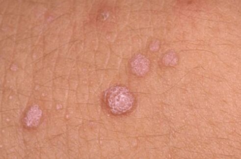 symptoms of human papillomavirus