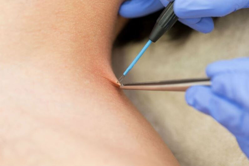 Papilloma removal procedure using electrocoagulation