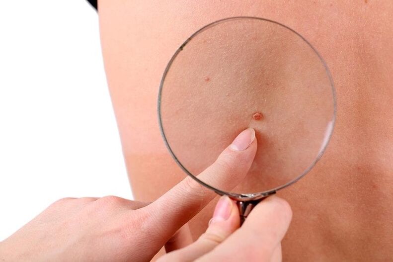 Papilloma under a magnifying glass