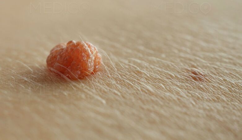papilloma on the skin
