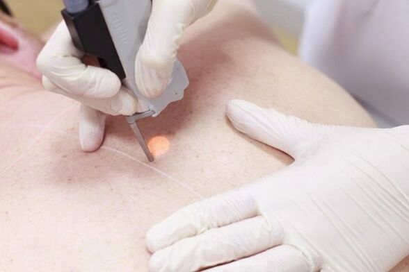 A popular method of laser removal of papillomas