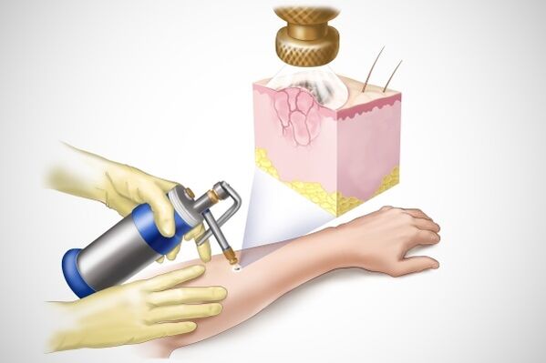 Papilloma cryosurgery