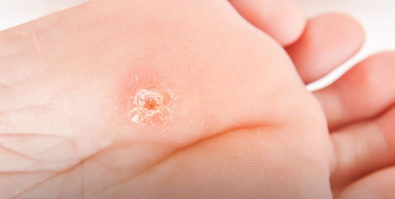 Plantar wart on foot