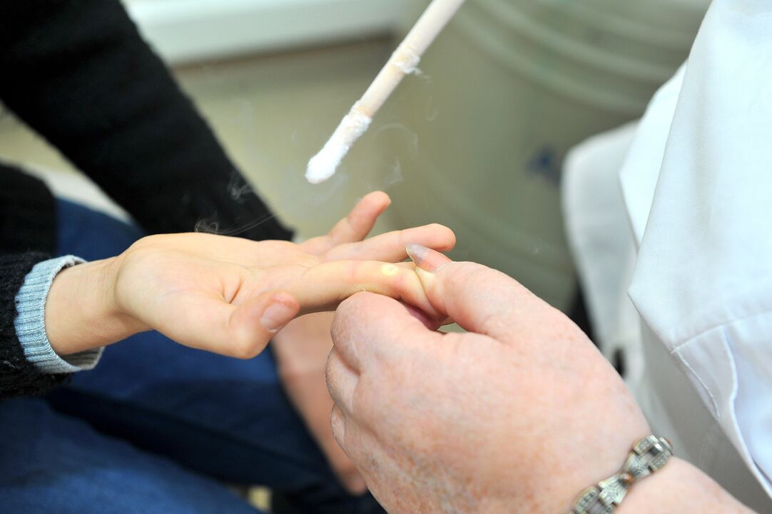 recovery period after removal of warts