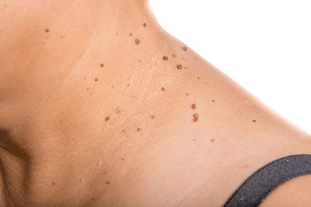 Complications of HPV