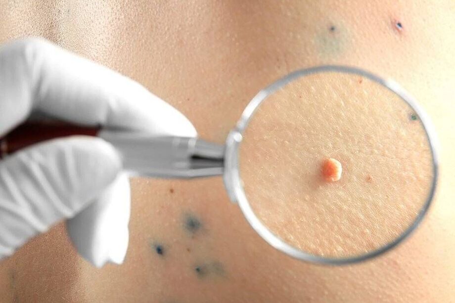 HPV treatment