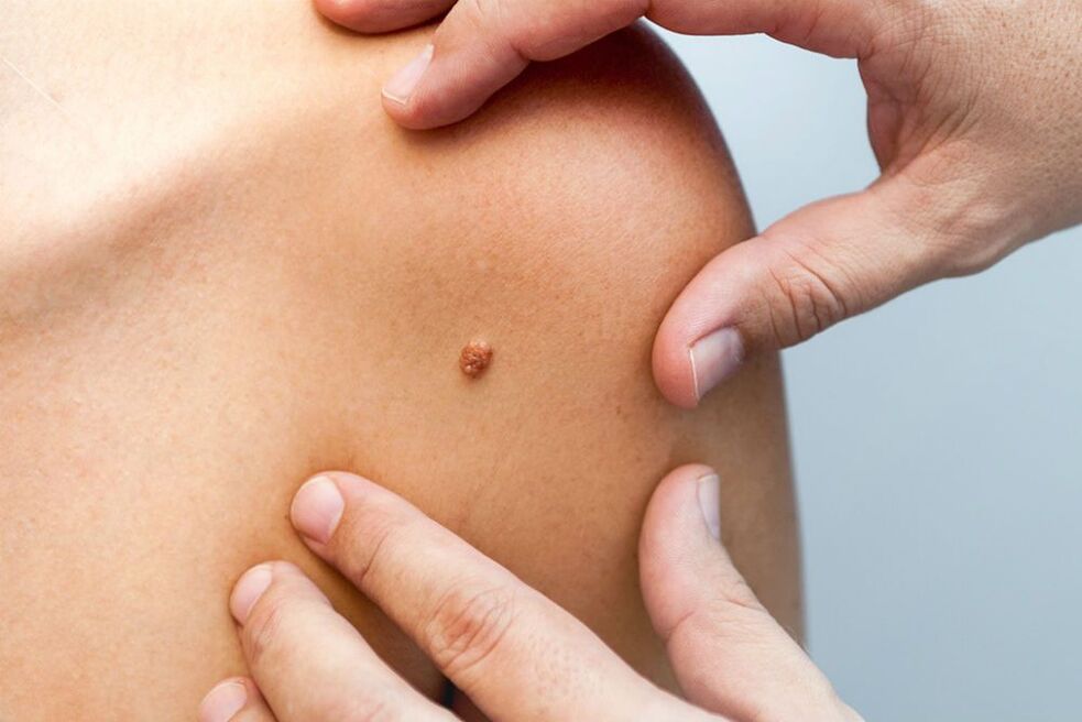 papillomas in the human body