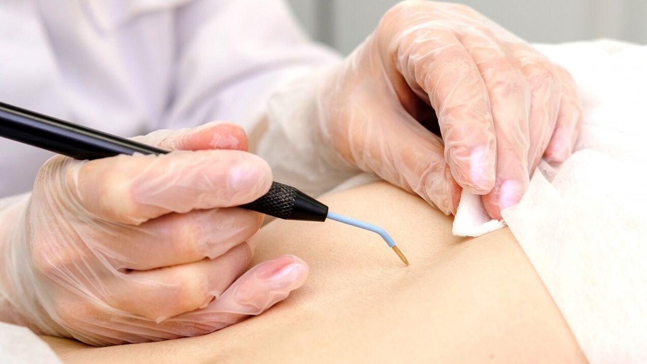 Ways to remove papillomas