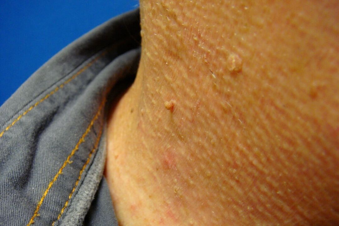 human neck papillomas